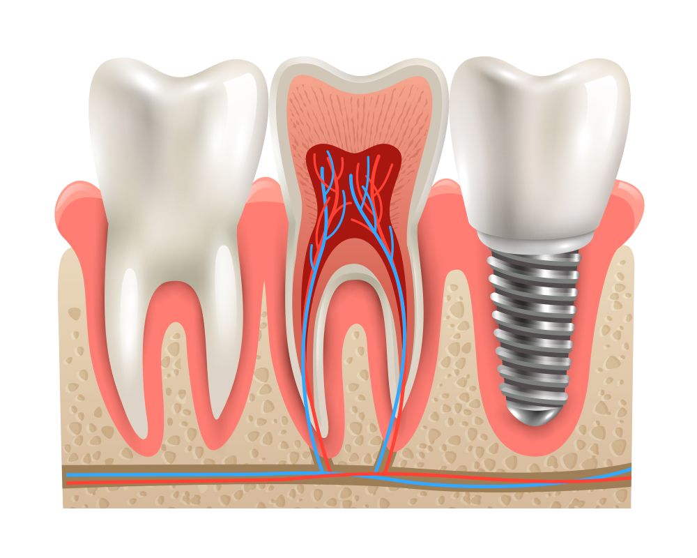 DENTAL IMPLANTS Premiere Dental Dental Implants New Jersey & PA