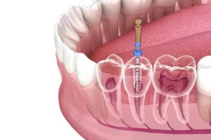 signs of root canal infection