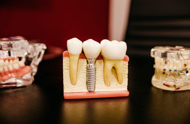 Are Dental Implants Necessary After Extraction