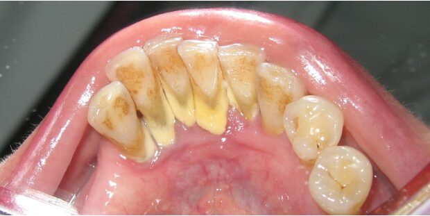 Tartar Breaking Off Teeth