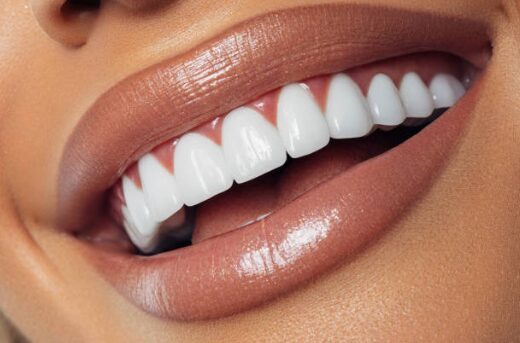 how does Invisalign work