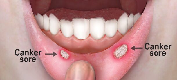 What Causes Red Spots on the Roof of Mouth?