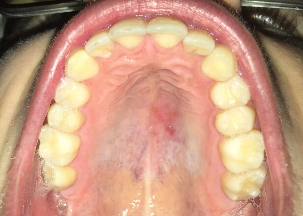 what causes red spots on the roof of mouth