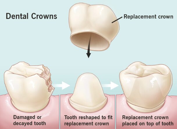 dental crown