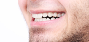 how much does it cost to fix a chipped tooth