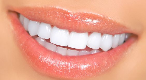 Can Bonded Teeth Be Whitened