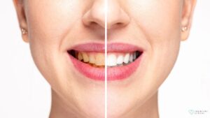 Teeth Cleaning Before and After