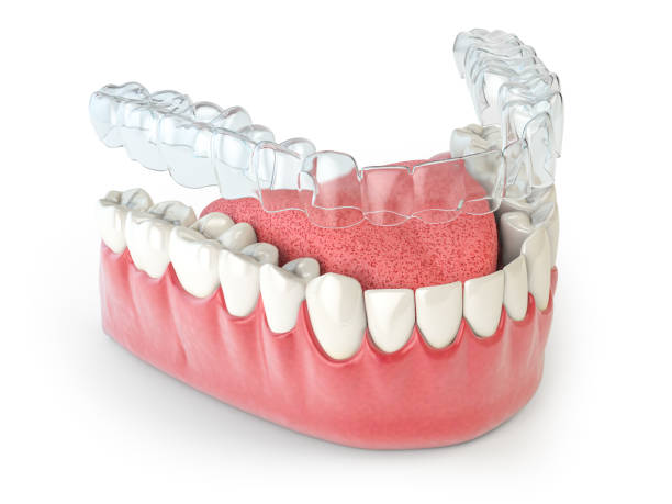 clear-aligners