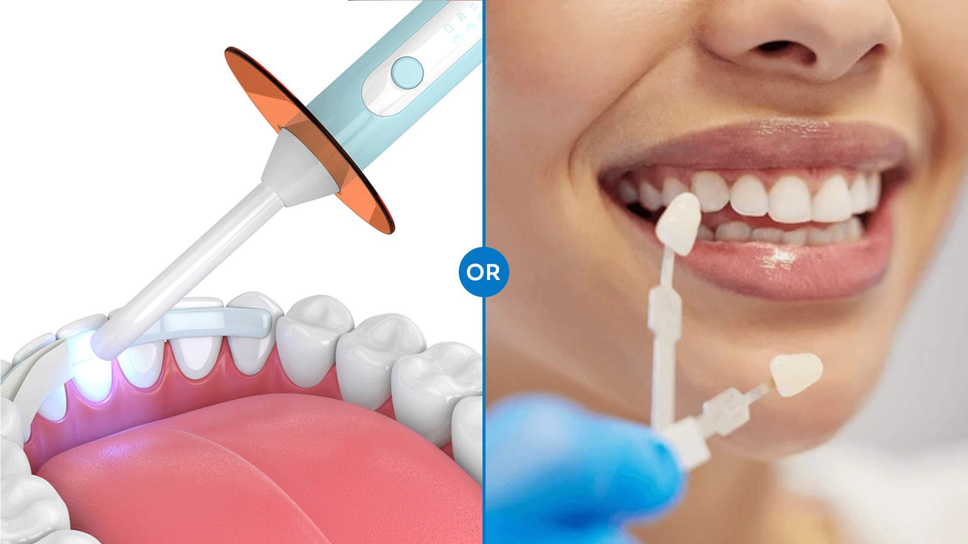 veneers