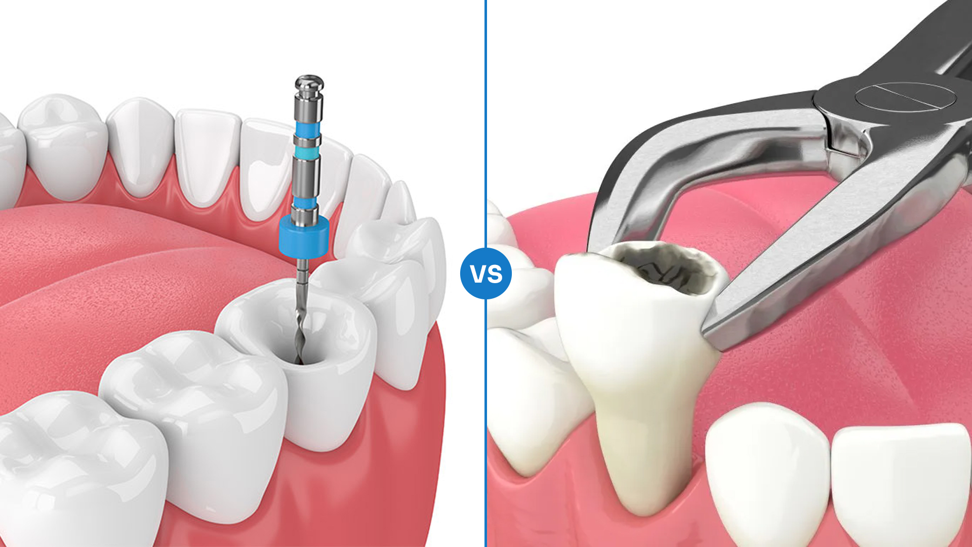 Root Canal