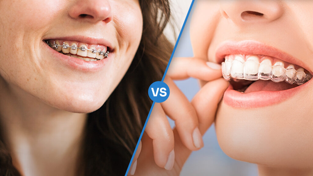 Invisalign