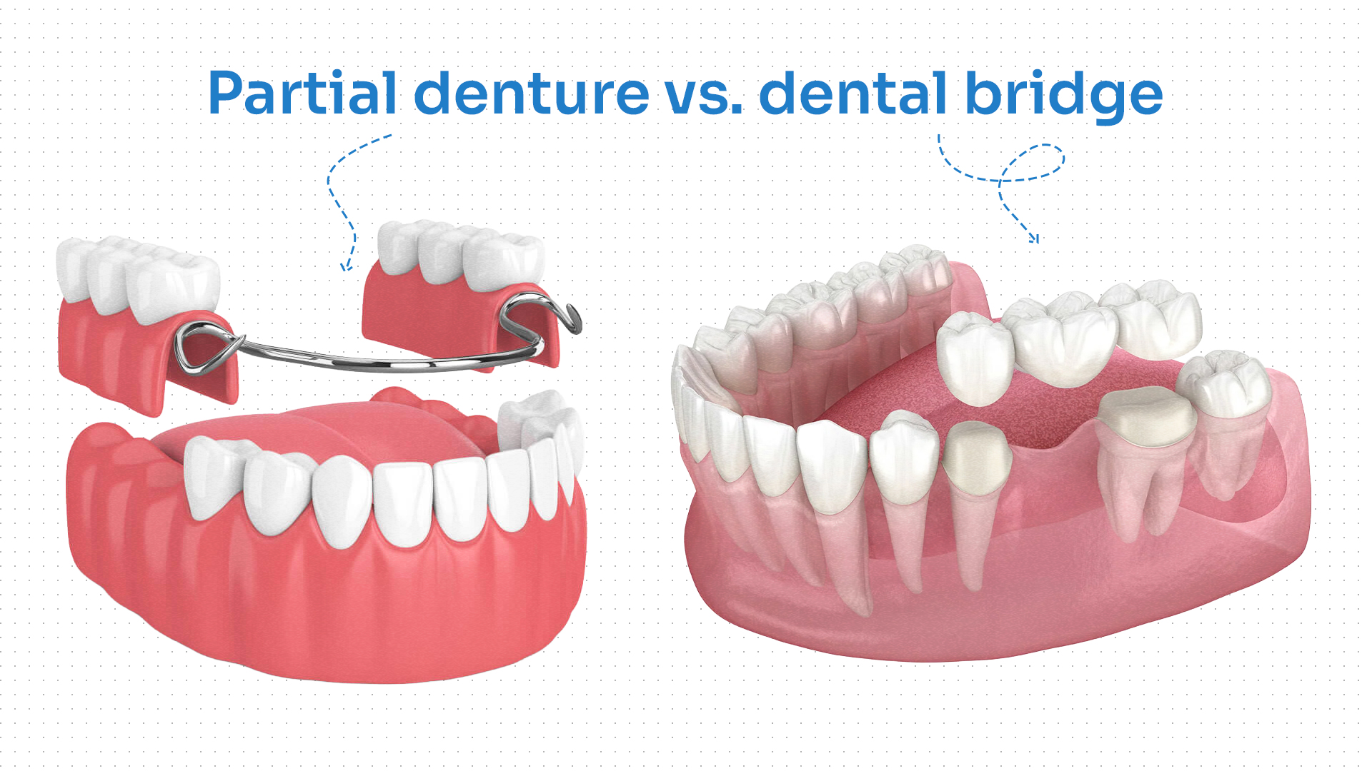 Partial Denture vs. Dental Bridge