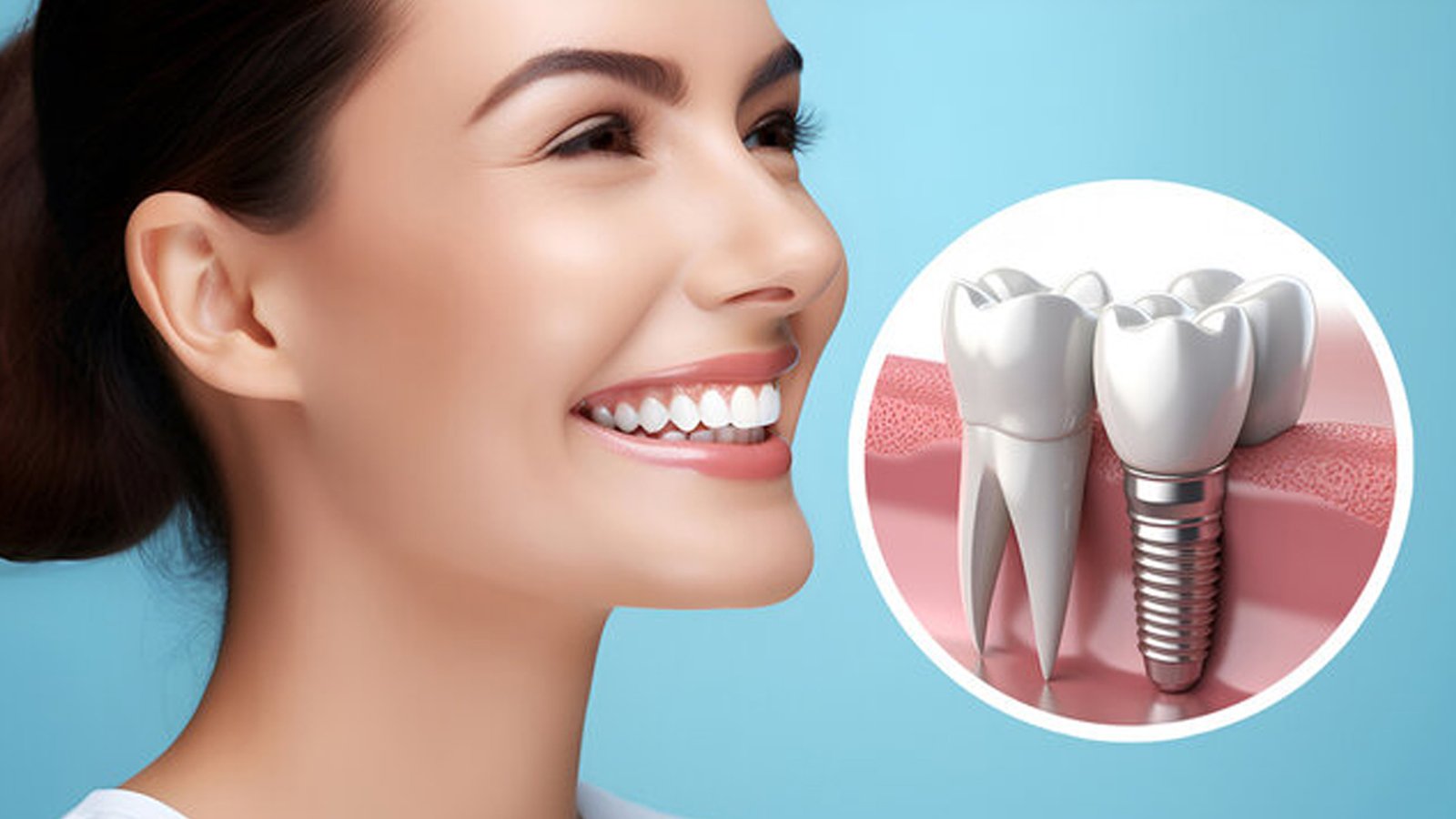 Dental Implants