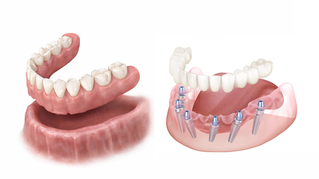 Dentures vs Full Arch Dental Implants