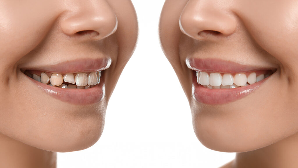 Dental Crown