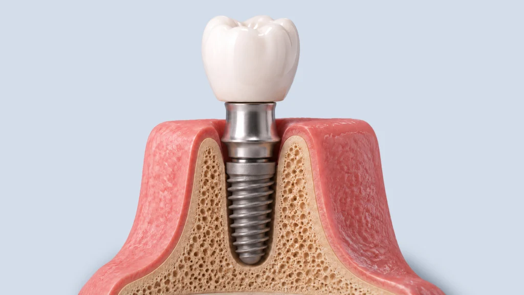 Dental Implant