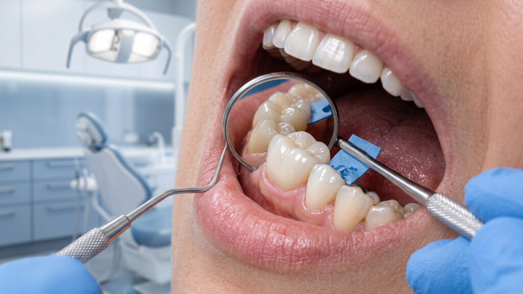 Crown Placement - Premiere Dental