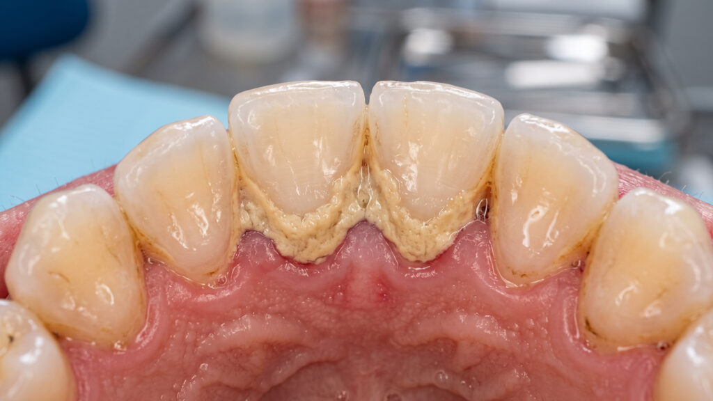 Hardened plaque and tartar buildup along the gumline at Premiere Dental
